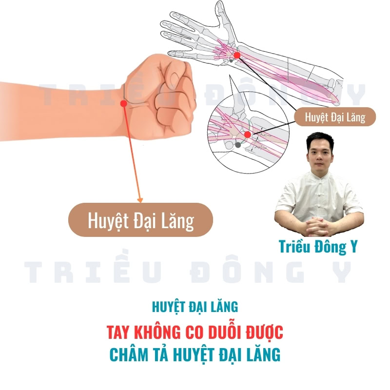 Tay co cứng châm 1 huyệt, tả huyệt đại lăng (大陵穴 - PC7) 2 Tay không co duỗi được châm tả huyệt đại lăng