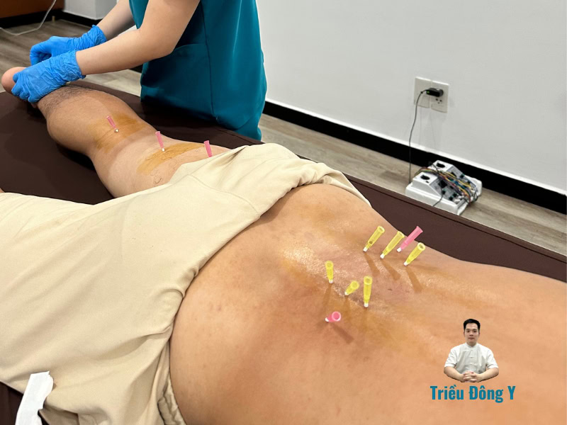 Cấy chỉ chữa trị bệnh thoát vị đĩa đệm có mang lại hiệu quả không?