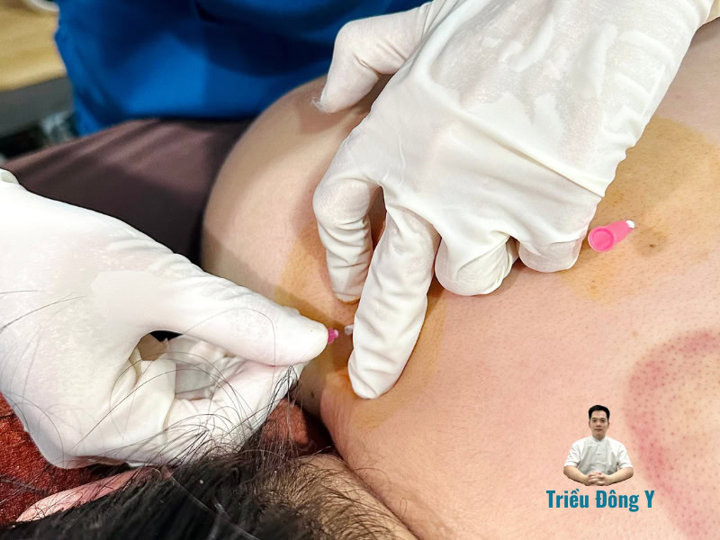 Dịch vụ cấy chỉ chữa hội chứng cổ vai gáy