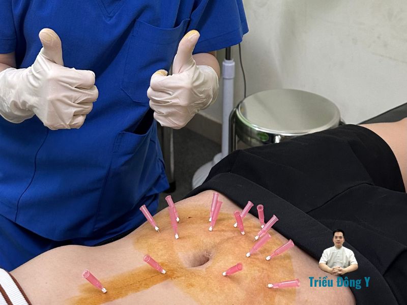 Dịch vụ cấy chỉ giảm béo, giảm mỡ hiệu quả, an toàn