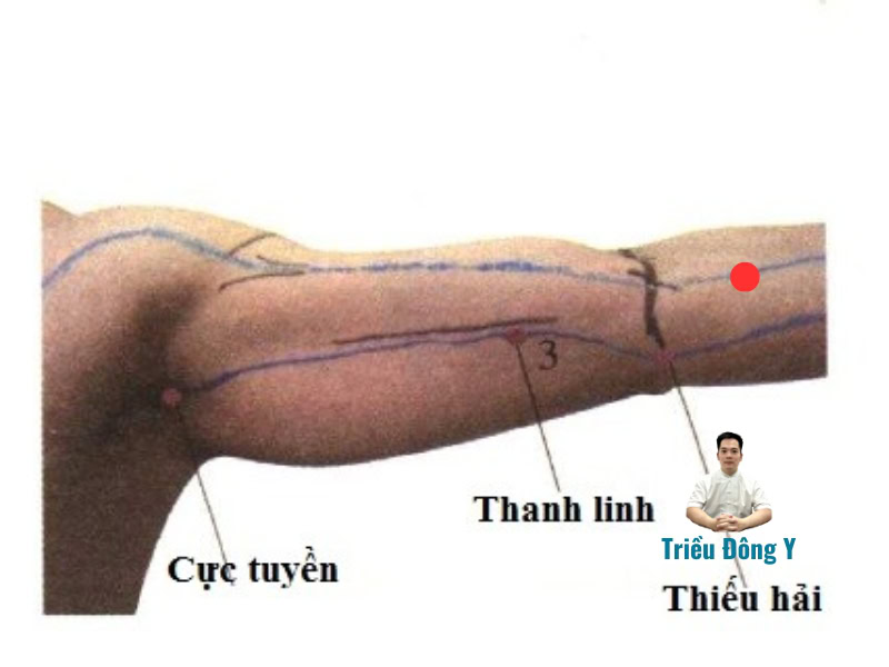 Huyệt Cực Tuyền 5 Vị trí huyệt cực tuyền