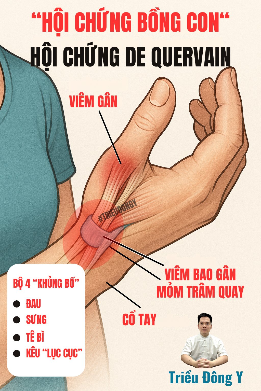 Bộ 4 "Hủy Diệt" Của Hội Chứng De Quervain - Hội Chứng Bồng Con