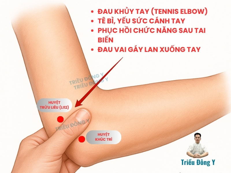 Huyệt Trửu Liêu (LI12): "Chìa Khóa" Vàng Khai Thông Bế Tắc, Chấm Dứt Đau Nhức Khuỷu Tay
