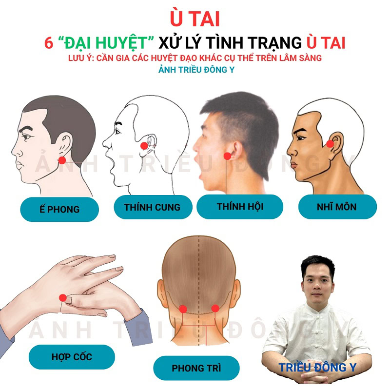 Công Thức Huyệt Điều Trị Ù Tai