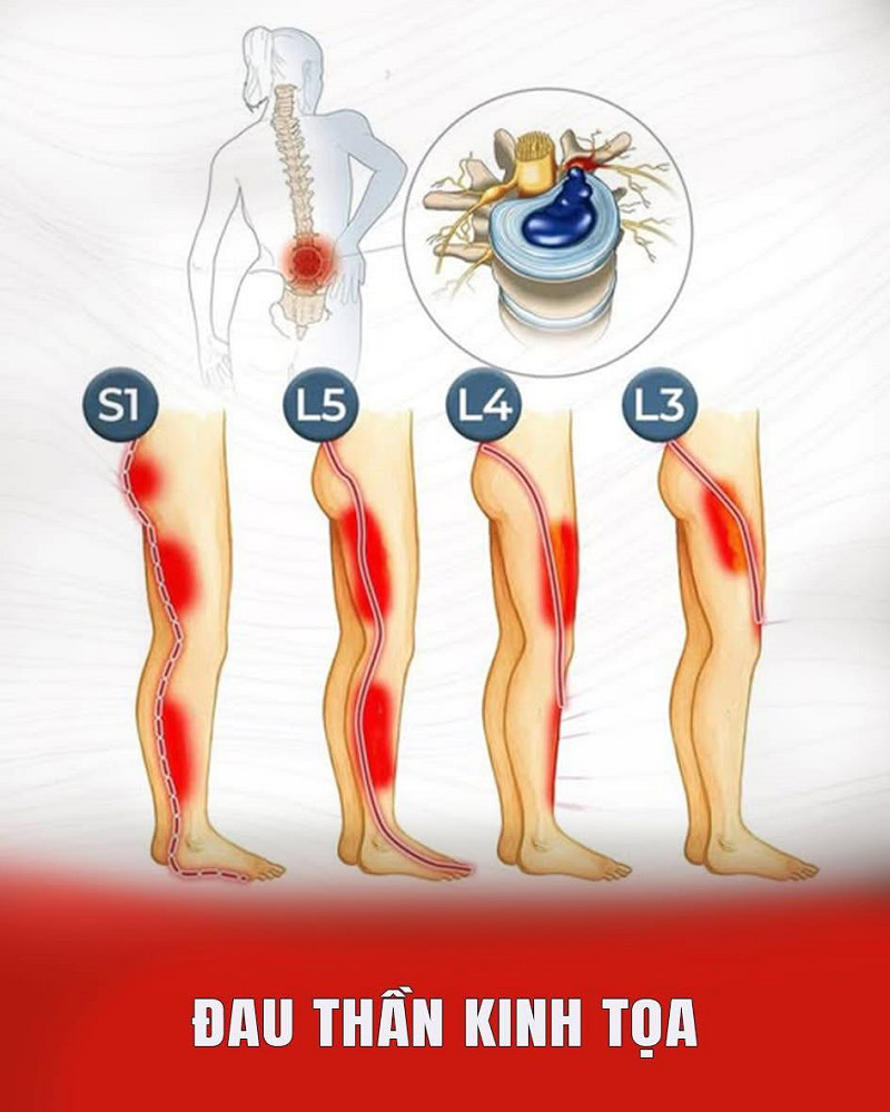 Các vị trí đau thần kinh tọa phụ thuộc và các rễ bị tổn thương