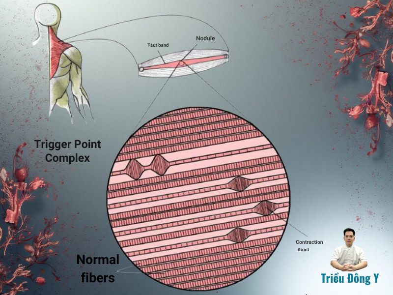 Trigger Point (Điểm Kích Hoạt) Là Gì? 3 Trigger Point (Điểm Kích Hoạt) Bản Chất Là Gì?
