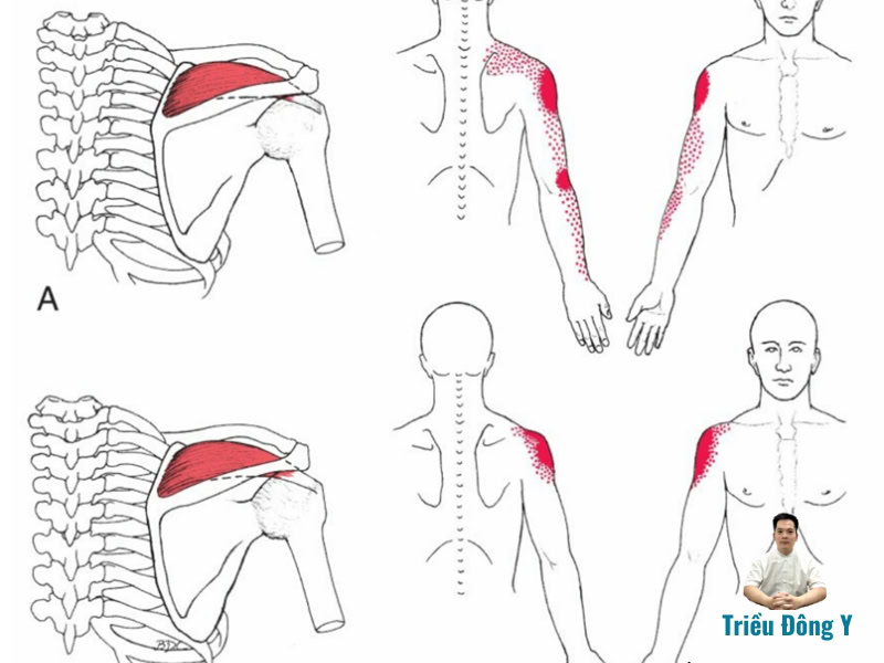 Trigger Point (Điểm Kích Hoạt) Là Gì? 4 Trigger Point điểm đau, điểm kích hoạt quy chiếu vùng vai