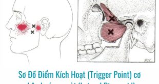Ảnh sơ đồ điểm kích hoạt Điểm Kích Hoạt (Trigger Point) cơ chân bướm ngoài (Lateral Pterygoid)
