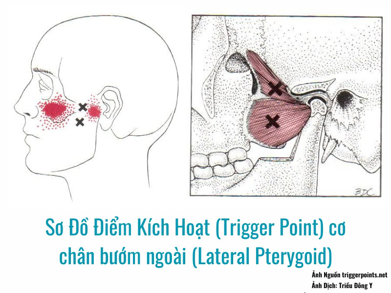 Điểm Kích Hoạt (Trigger Point) cơ chân bướm ngoài (Lateral Pterygoid) 2 Ảnh sơ đồ điểm kích hoạt Điểm Kích Hoạt (Trigger Point) cơ chân bướm ngoài (Lateral Pterygoid)