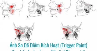 Ảnh sơ đồ Điểm Kích Hoạt (Trigger Point) Cơ chân bướm trong (Medial Pterygoid)