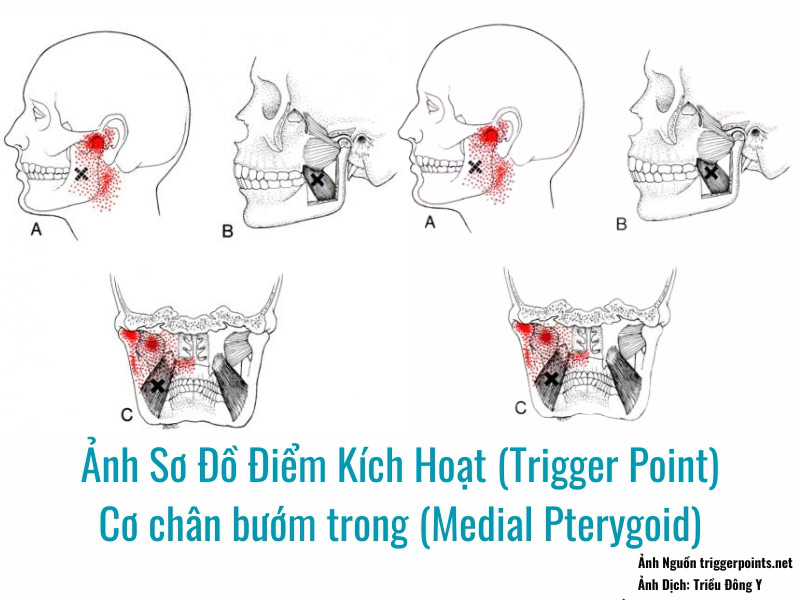 Điểm Kích Hoạt (Trigger Point) Cơ chân bướm trong (Medial Pterygoid) 2 Ảnh sơ đồ Điểm Kích Hoạt (Trigger Point) Cơ chân bướm trong (Medial Pterygoid)