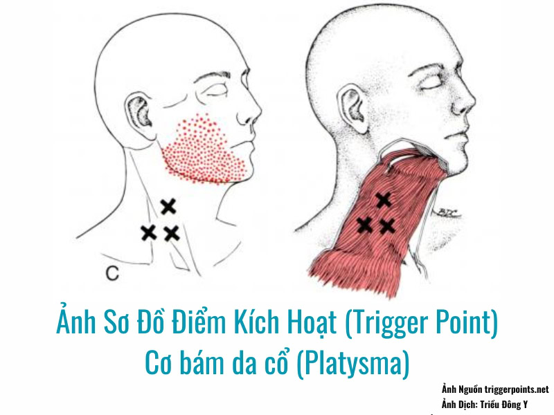 Điểm Kích Hoạt (Trigger Point) Cơ bám da cổ (Platysma) 2 Ảnh sơ đồ Điểm Kích Hoạt (Trigger Point) Cơ bám da cổ (Platysma)