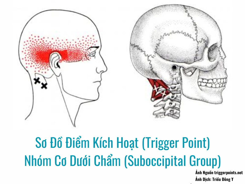 Điểm Kích Hoạt (Trigger Point) Cơ Dưới Chẩm (Suboccipital Group) 2 Ảnh Sơ Đồ Điểm Kích Hoạt (Trigger Point) Nhóm Cơ Dưới Chẩm (Suboccipital Group)