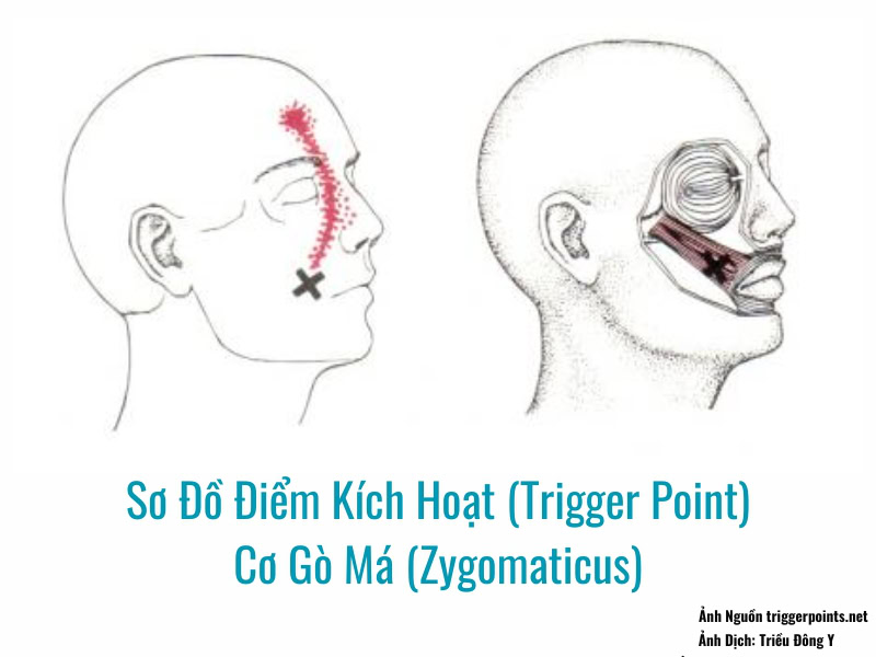Ảnh sơ đồ Điểm Kích Hoạt (Trigger Point) Cơ Gò Má (Zygomaticus)