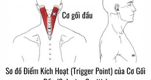 Sơ đồ Điểm Kích Hoạt (Trigger Point) của Cơ Gối Đầu (Splenius Capitis)