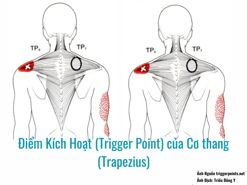 Điểm Kích Hoạt (Trigger Point) của Cơ thang (Trapezius) gây đau vùng mỏm sau vai