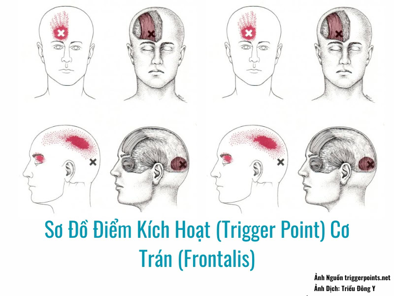 Hình ảnh sơ đồ Điểm Kích Hoạt (Trigger Point) Cơ Trán (Frontalis)