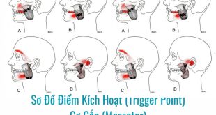 Ảnh sơ đồ Điểm Kích Hoạt (Trigger Point) Cơ Cắn (Masseter)