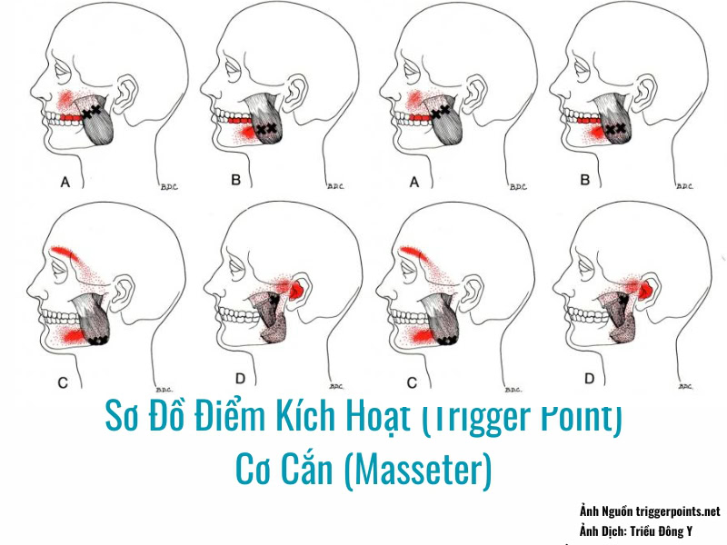 Điểm Kích Hoạt (Trigger Point) Cơ Cắn (Masseter) 2 Ảnh sơ đồ Điểm Kích Hoạt (Trigger Point) Cơ Cắn (Masseter)