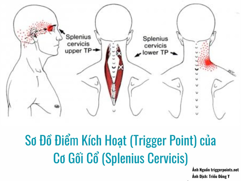 Ảnh sơ đồ Điểm Kích Hoạt (Trigger Point) của Cơ Gối Cổ (Splenius Cervicis) gây đau vùng đuôi mắt thái dương và chân cổ vai
