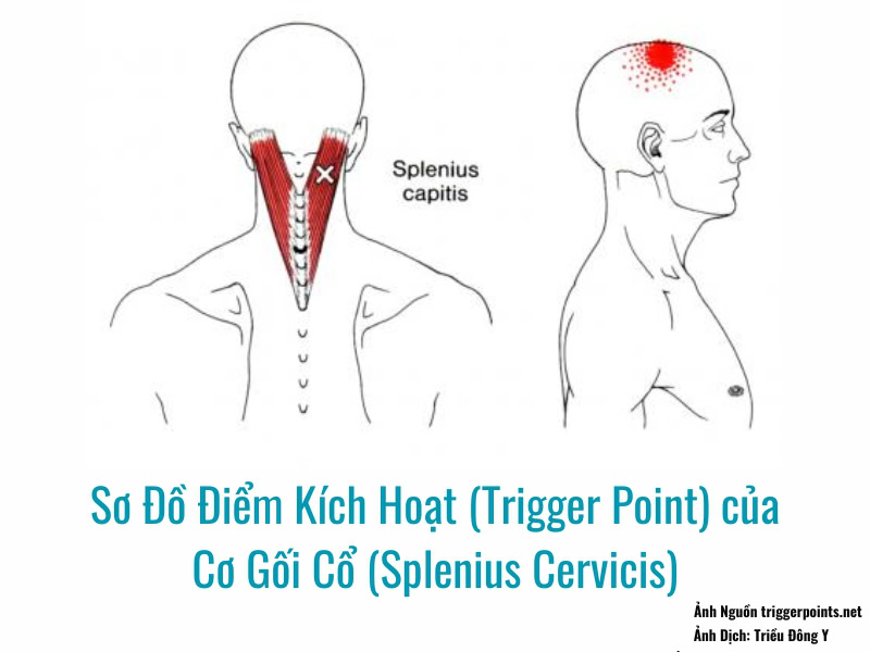 Ảnh sơ đồ Điểm Kích Hoạt (Trigger Point) của Cơ Gối Cổ (Splenius Cervicis) đau vùng đỉnh đầu