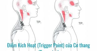 Điểm Kích Hoạt (Trigger Point) của Cơ thang (Trapezius) gây đau đầu vùng thái dương