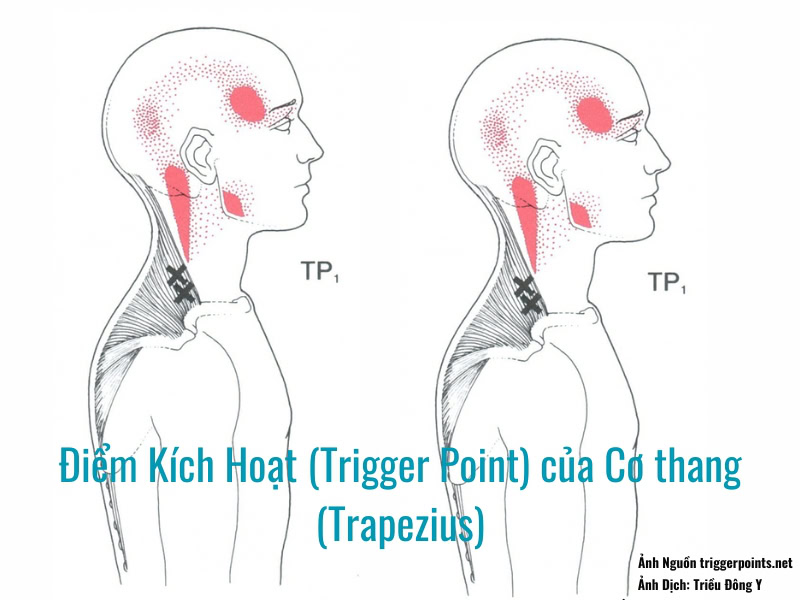 Điểm Kích Hoạt (Trigger Point) của Cơ thang (Trapezius) gây đau đầu vùng thái dương