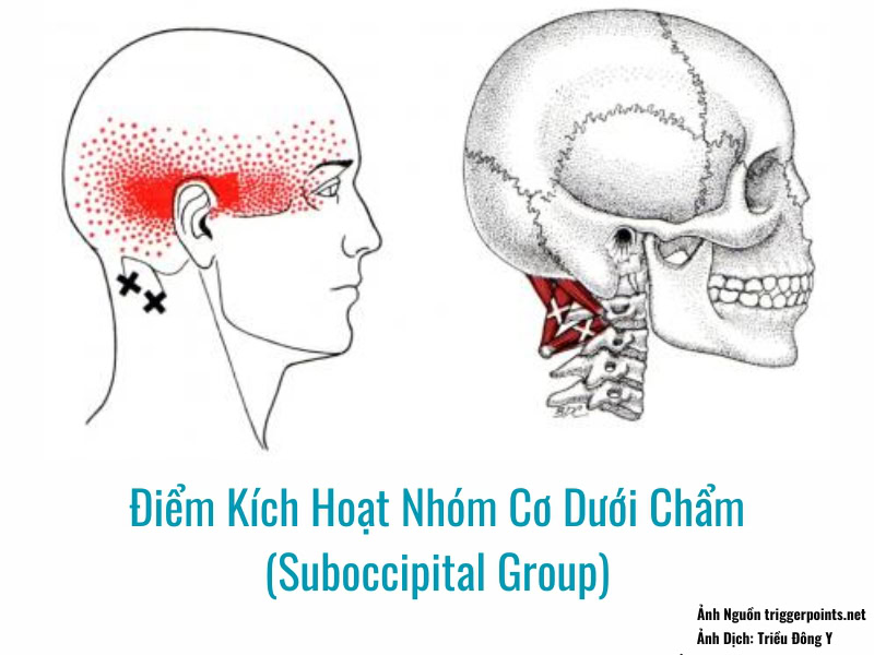 Hình Ảnh Sơ Đồ Điểm Kích Hoạt (Trigger Point) Cơ Dưới Chẩm (Suboccipital Group)