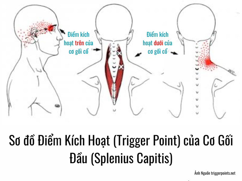Sơ đồ Điểm Kích Hoạt (Trigger Point) của Cơ Gối Đầu (Splenius Capitis) Trên và Dưới