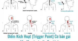 Sơ đồ ảnh Điểm Kích Hoạt (Trigger Point) Cơ bán gai đầu (Semispinalis Capitis)