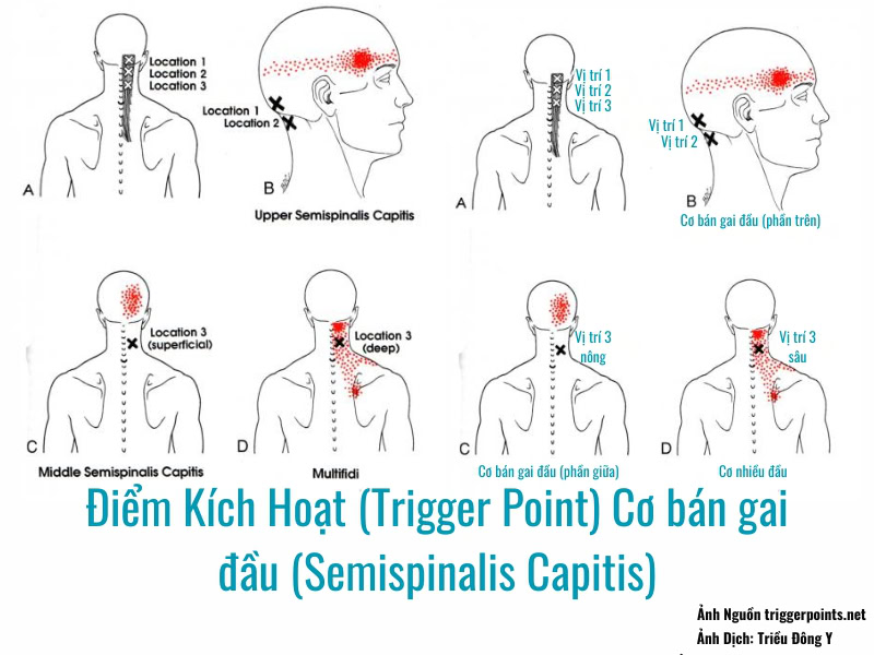 Sơ đồ ảnh Điểm Kích Hoạt (Trigger Point) Cơ bán gai đầu (Semispinalis Capitis)