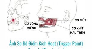 Ảnh sơ đồ Điểm Kích Hoạt (Trigger Point) Cơ mút (Buccinator)