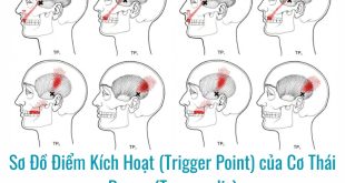Hình ảnh sơ đồ Điểm Kích Hoạt (Trigger Point) của Cơ Thái Dương (Temporalis)