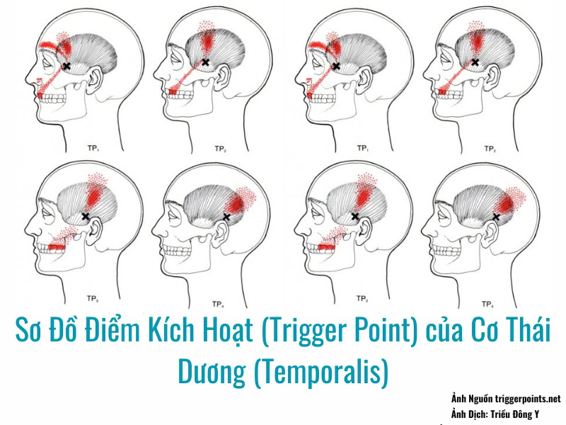Hình ảnh sơ đồ Điểm Kích Hoạt (Trigger Point) của Cơ Thái Dương (Temporalis)