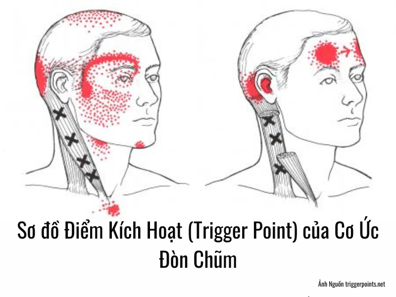 Sơ đồ Điểm Kích Hoạt (Trigger Point) của Cơ Ức Đòn Chũm