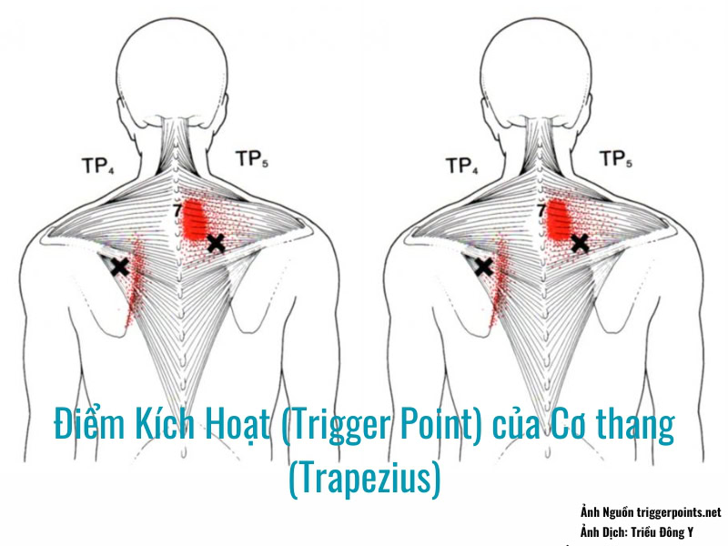 Điểm Kích Hoạt (Trigger Point) của Cơ thang (Trapezius) gây đau phần vai gáy
