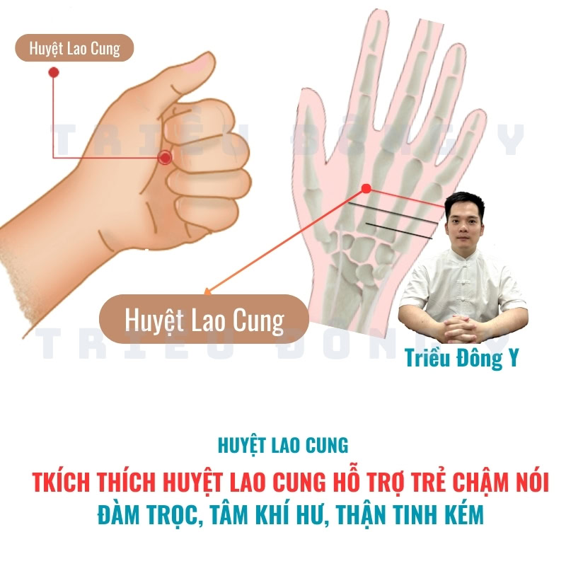 Kích thích huyệt Lao Cung hỗ trợ trẻ chậm nói với nguyên nhân Đàm trọc, Tâm khí hư, Thận tinh kém theo đông y