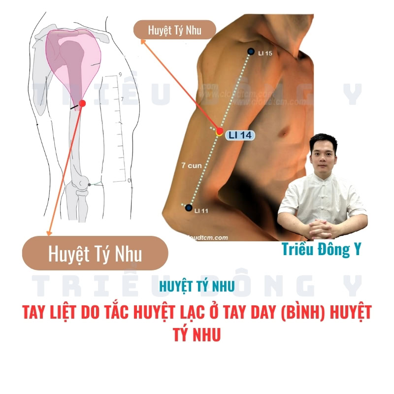 Giải Mã Huyệt Tý Nhu (臂臑穴 - LI14): Chìa Khóa "Vàng" Trong Điều Trị Liệt Chi Trên Do Bế Tắc Kinh Lạc