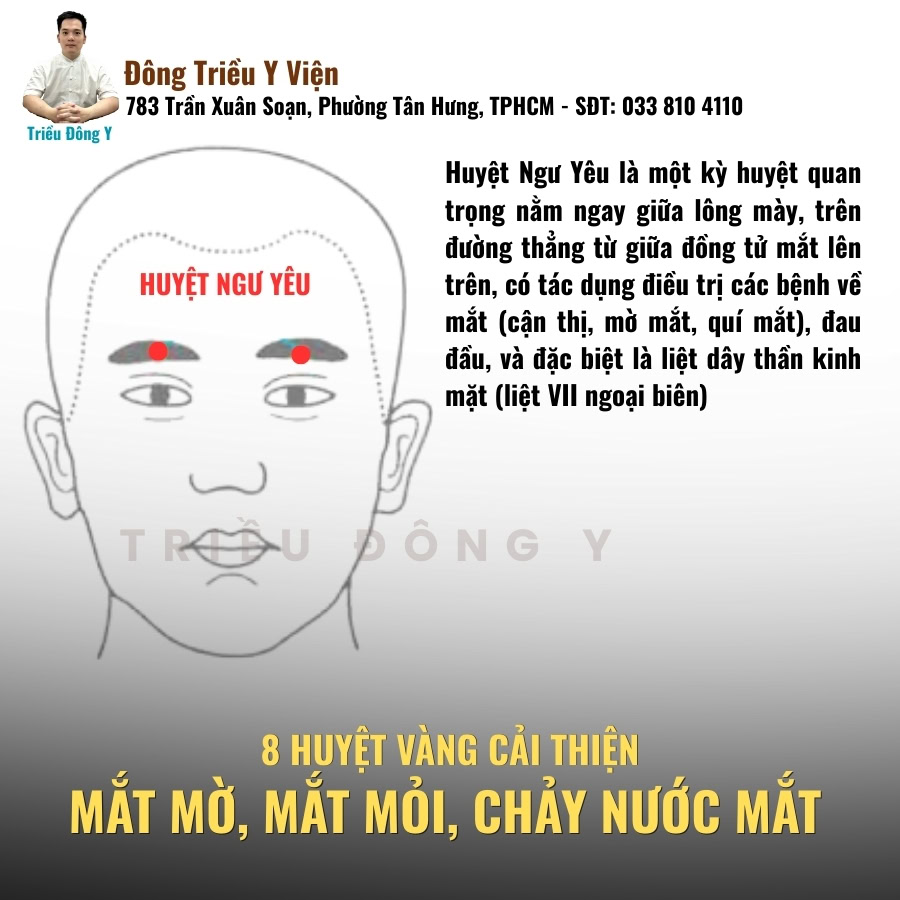 Huyệt ngư yêu huyệt vàng điều trị mờ mắt, nhức mắt, chảy nước mắt