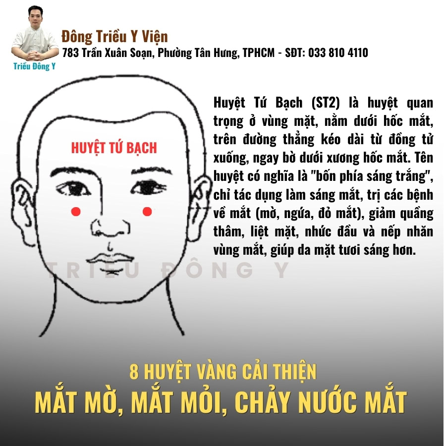 Huyệt tứ bạch huyệt vàng điều trị mờ mắt, nhức mắt, chảy nước mắt