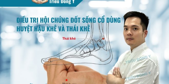 Điều Trị Hội Chứng Đốt Sống Cổ Dùng Huyệt Hậu Khê và Thái Khê