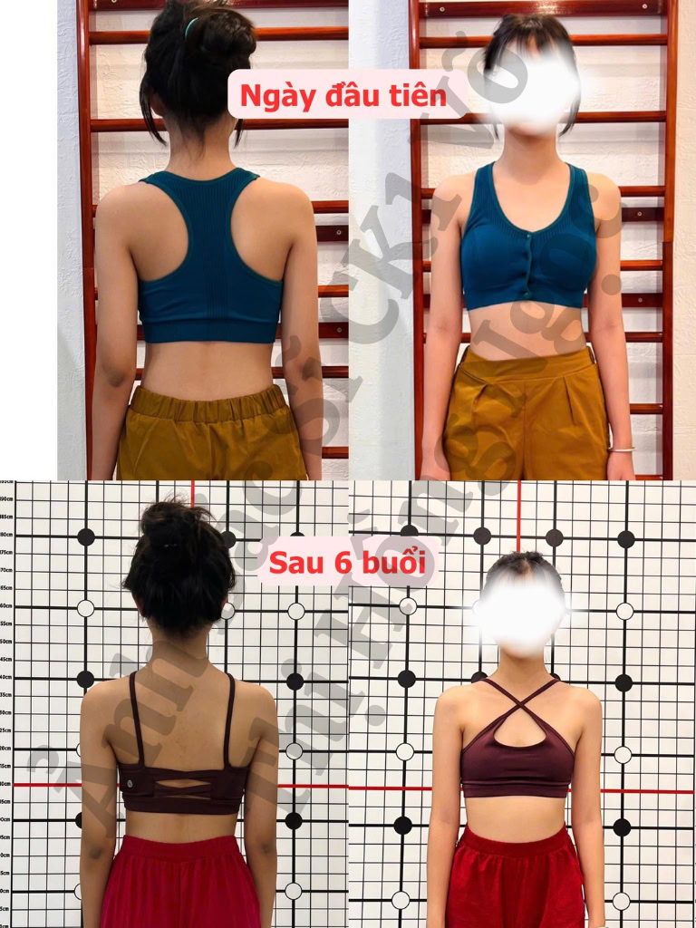 8 Bác sĩ khám chữa cong vẹo cột sống giỏi TPHCM uy tín 13 Kết quả sau khi tập trị liệu cong vẹo cột sống bởi bác sĩ Ngọc Ơi